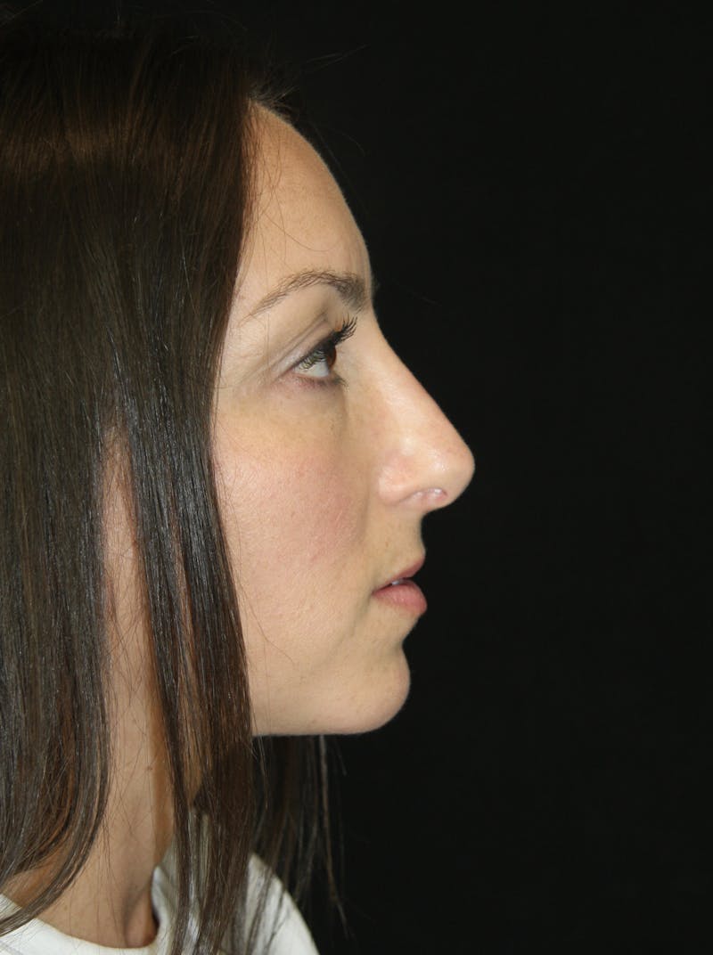 Rhinoplasty Before & After Gallery - Patient 182104893 - Image 4