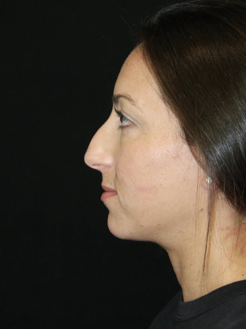 Rhinoplasty Before & After Gallery - Patient 182104893 - Image 5