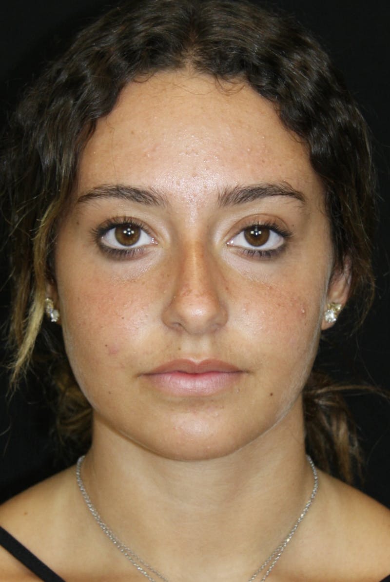 Rhinoplasty Before & After Gallery - Patient 182104944 - Image 1