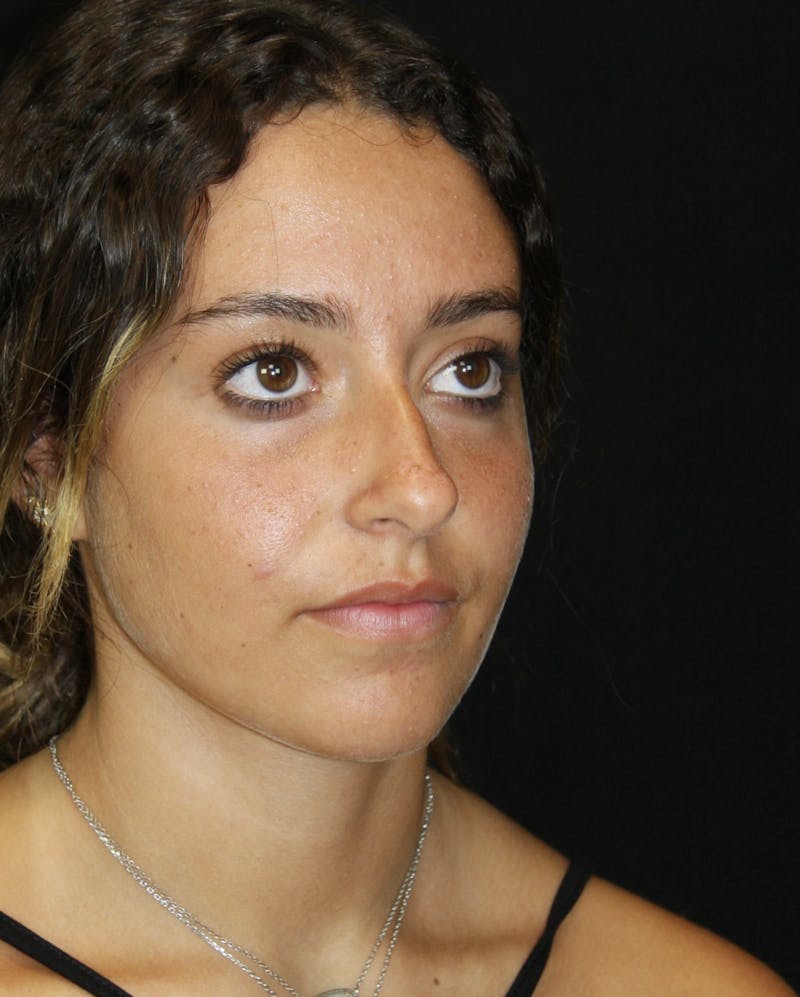 Rhinoplasty Before & After Gallery - Patient 182104944 - Image 3