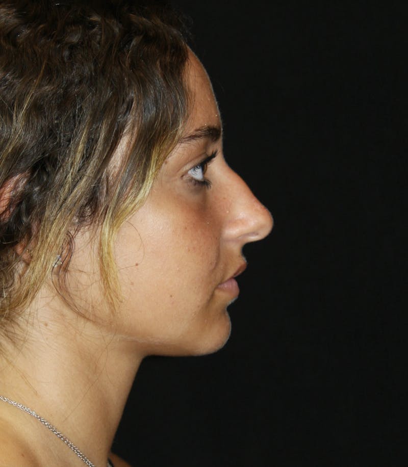 Rhinoplasty Before & After Gallery - Patient 182104944 - Image 5