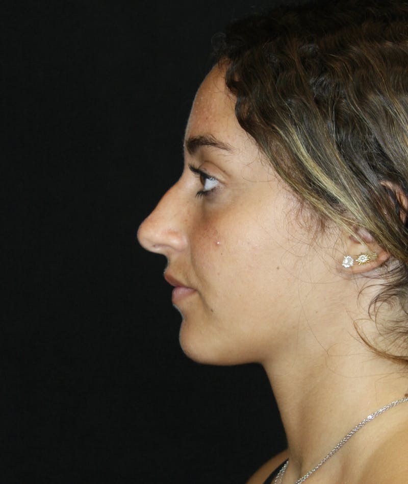 Rhinoplasty Before & After Gallery - Patient 182104944 - Image 7