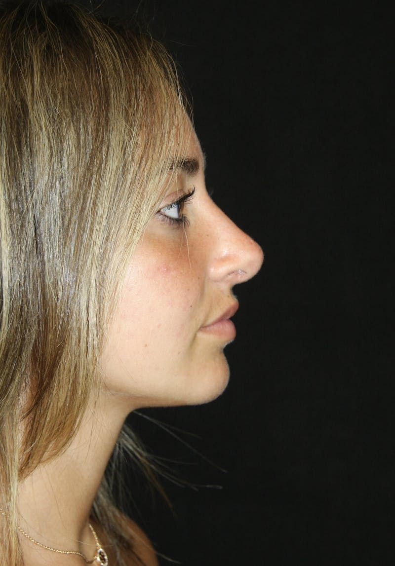 Rhinoplasty Before & After Gallery - Patient 182104944 - Image 6