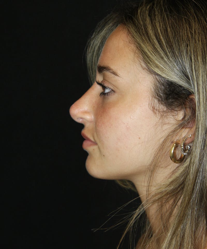 Rhinoplasty Before & After Gallery - Patient 182104944 - Image 8