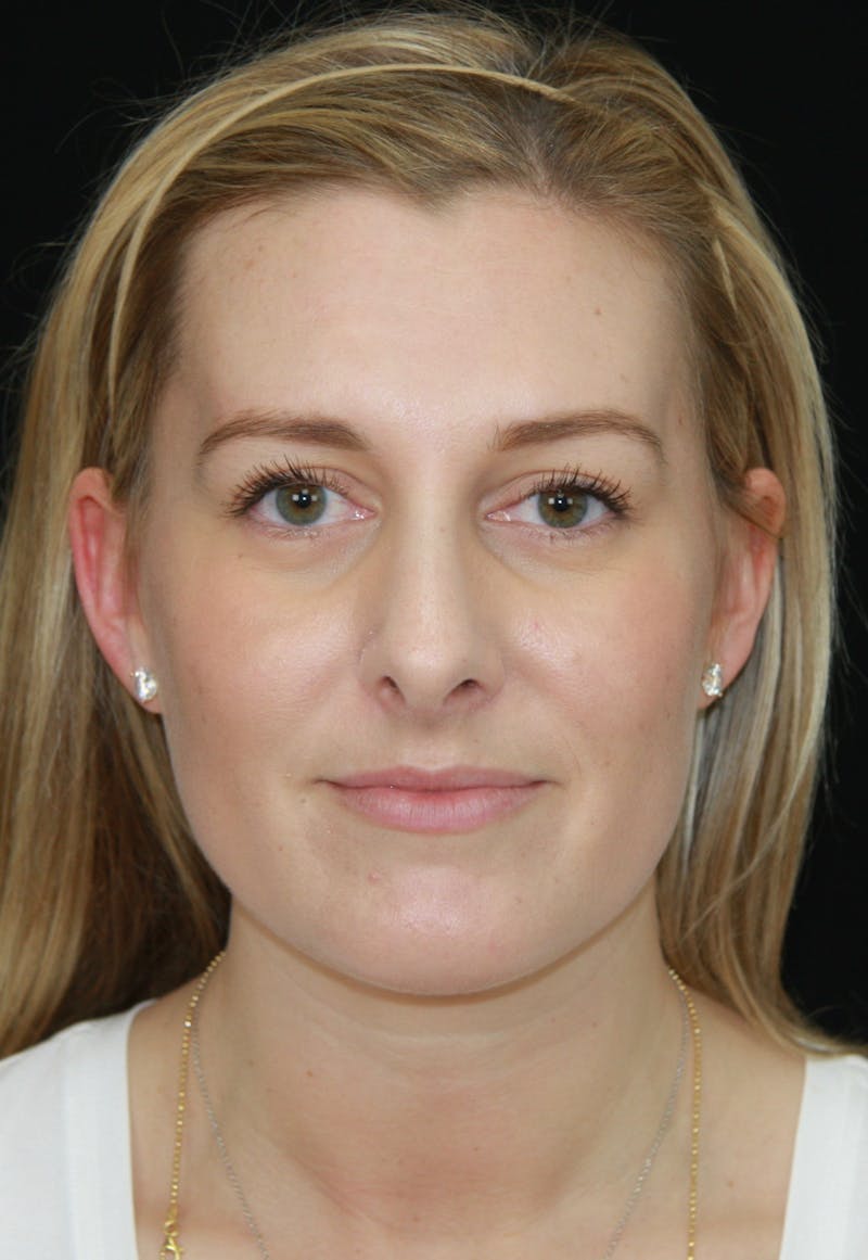Rhinoplasty Before & After Gallery - Patient 182106754 - Image 2