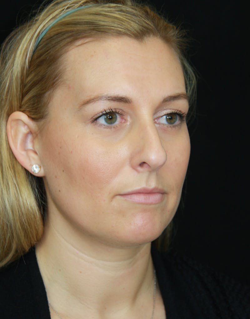 Rhinoplasty Before & After Gallery - Patient 182106754 - Image 3