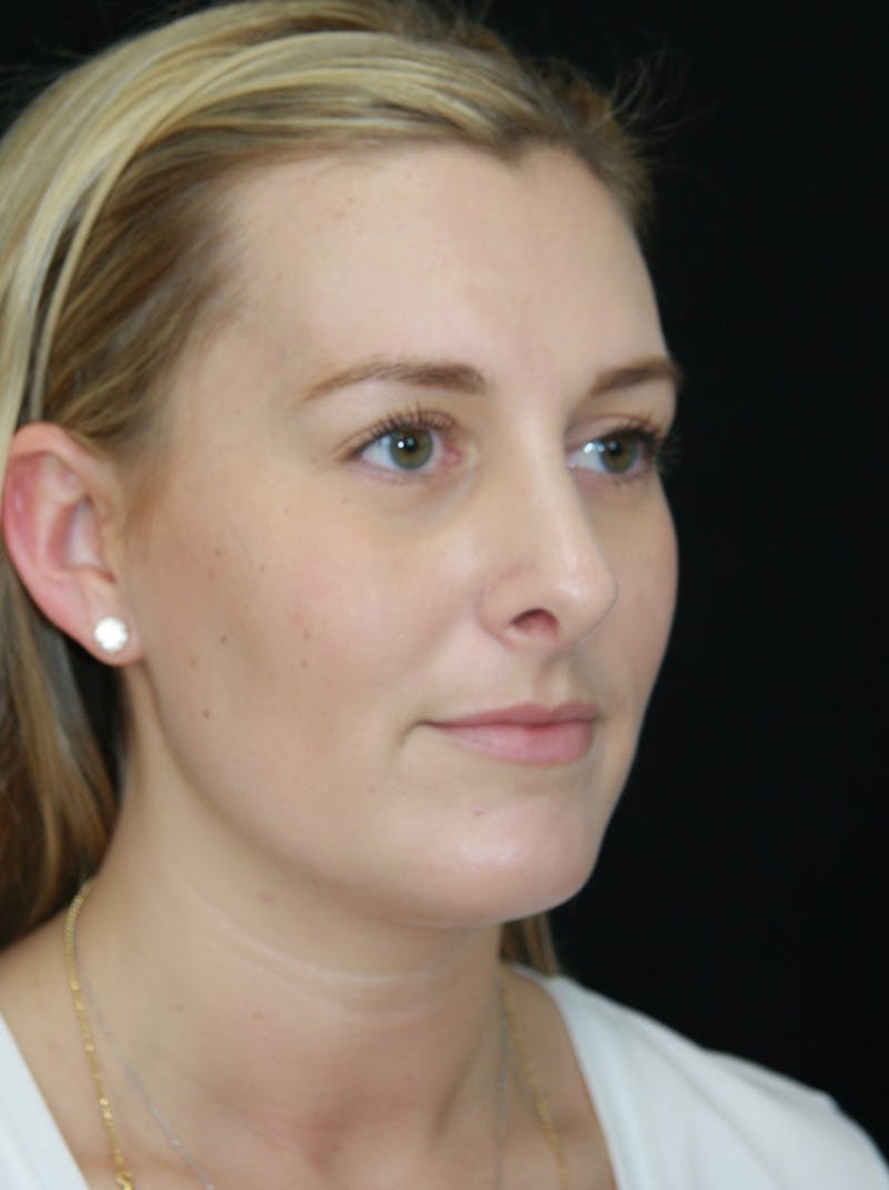 Rhinoplasty Before & After Gallery - Patient 182106754 - Image 4
