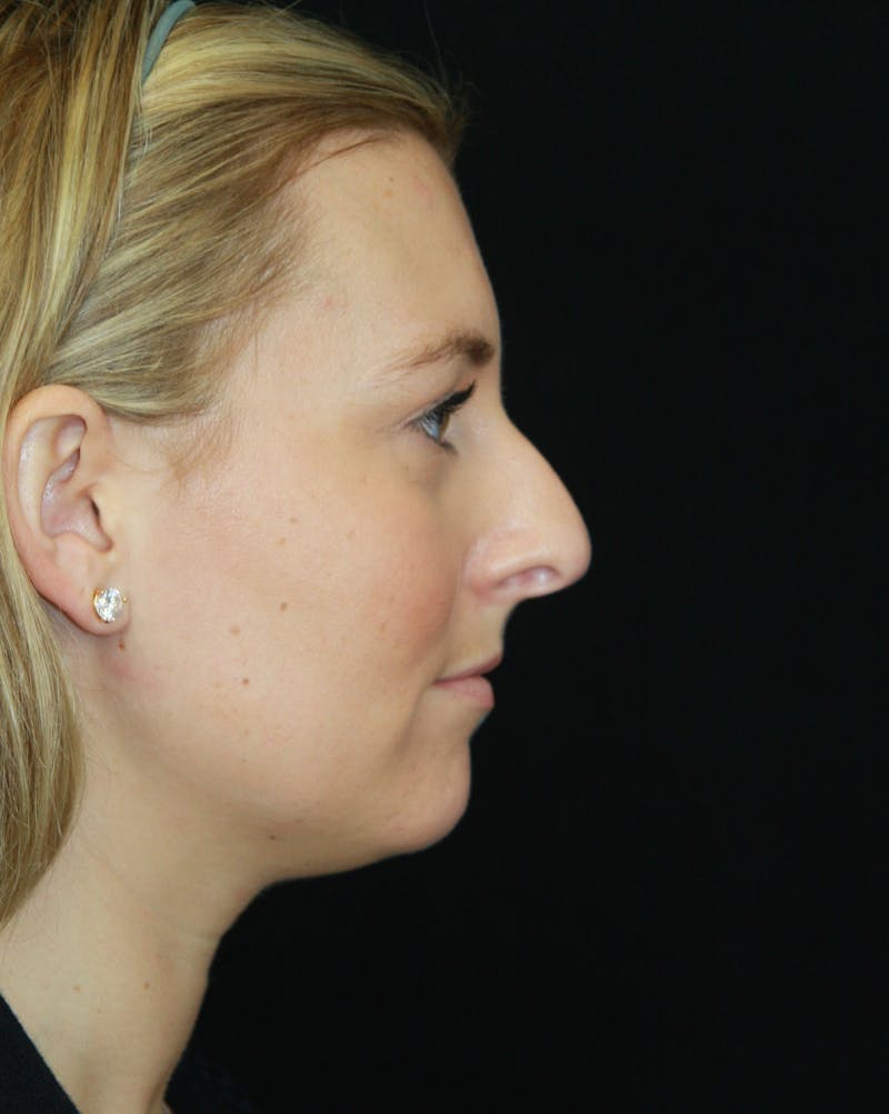 Rhinoplasty Before & After Gallery - Patient 182106754 - Image 5
