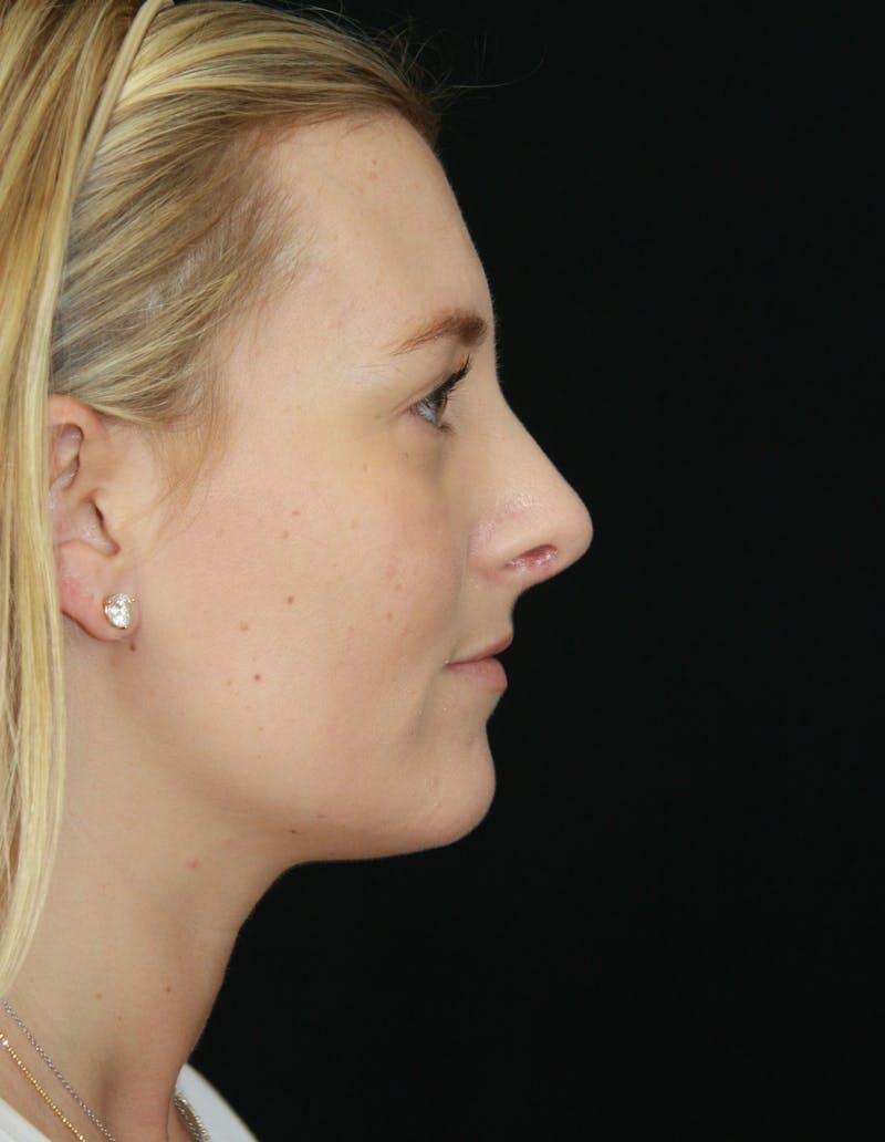 Rhinoplasty Before & After Gallery - Patient 182106754 - Image 6