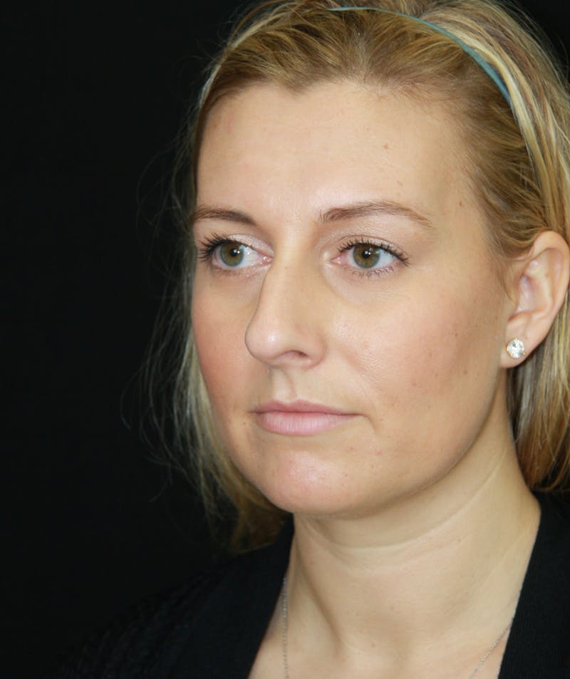 Rhinoplasty Before & After Gallery - Patient 182106754 - Image 7