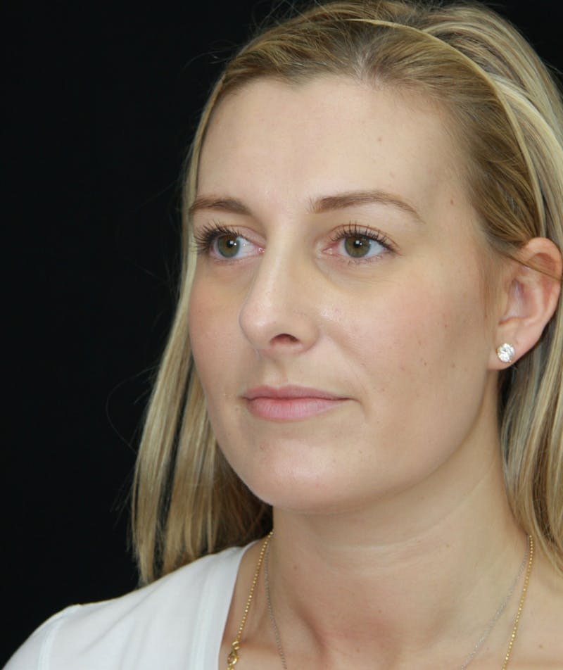 Rhinoplasty Before & After Gallery - Patient 182106754 - Image 8