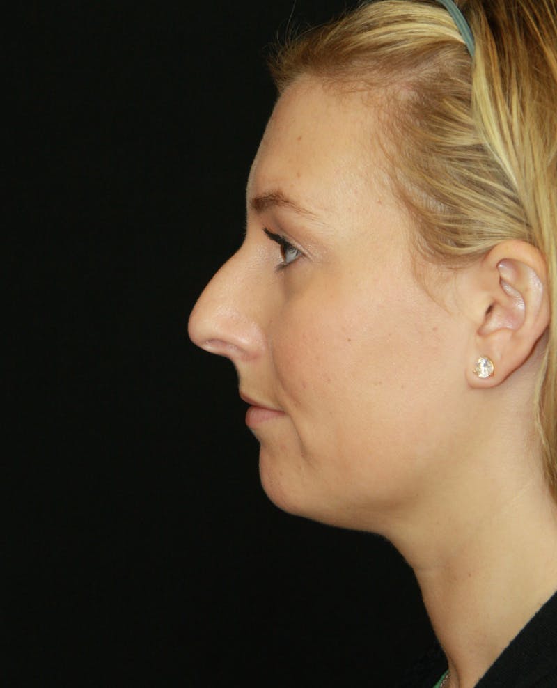 Rhinoplasty Before & After Gallery - Patient 182106754 - Image 9