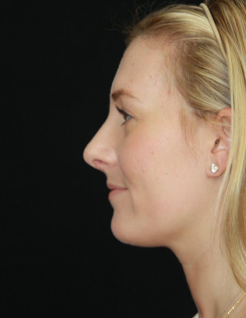 Rhinoplasty Before & After Gallery - Patient 182106754 - Image 10