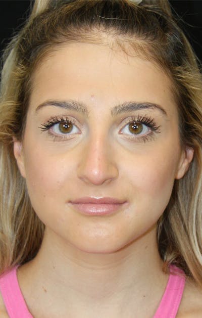 Rhinoplasty Before & After Gallery - Patient 189885106 - Image 1
