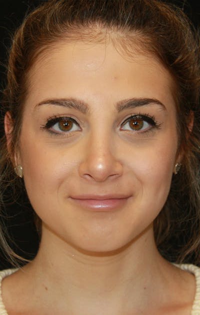 Rhinoplasty Before & After Gallery - Patient 189885106 - Image 2