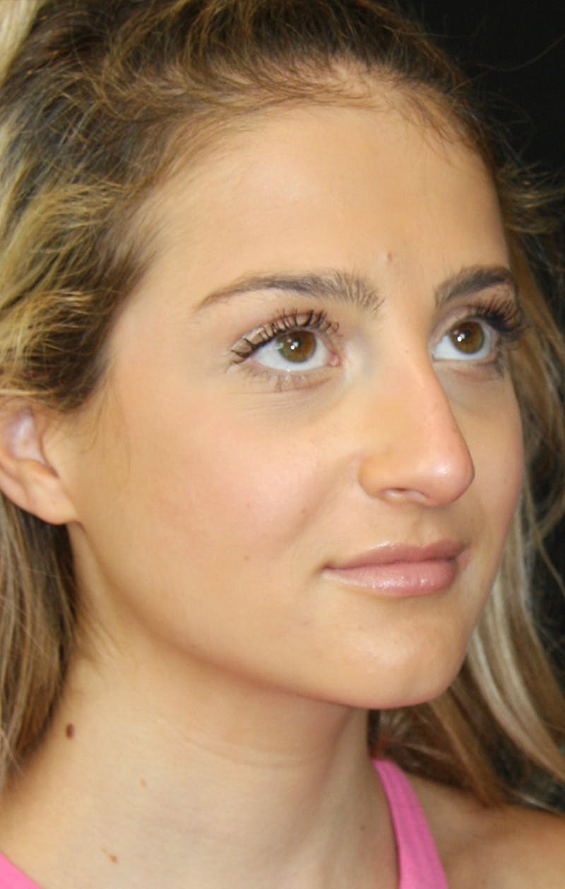 Rhinoplasty Before & After Gallery - Patient 189885106 - Image 3