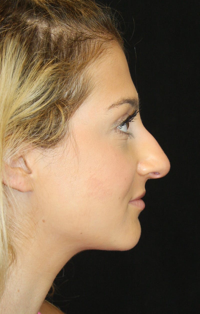 Rhinoplasty Before & After Gallery - Patient 189885106 - Image 5