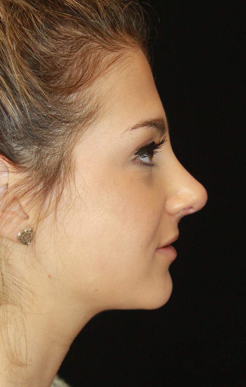 Rhinoplasty Before & After Gallery - Patient 189885106 - Image 6