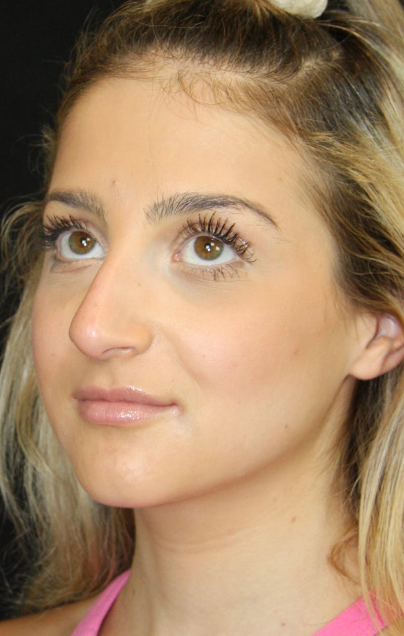 Rhinoplasty Before & After Gallery - Patient 189885106 - Image 7