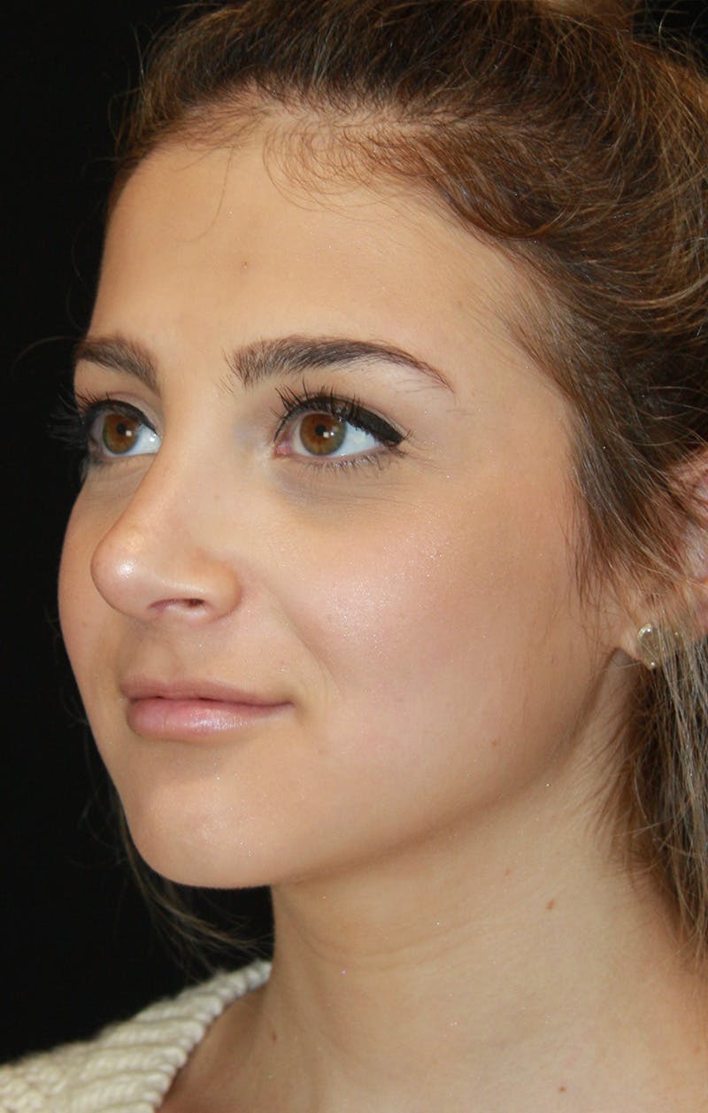 Rhinoplasty Before & After Gallery - Patient 189885106 - Image 8