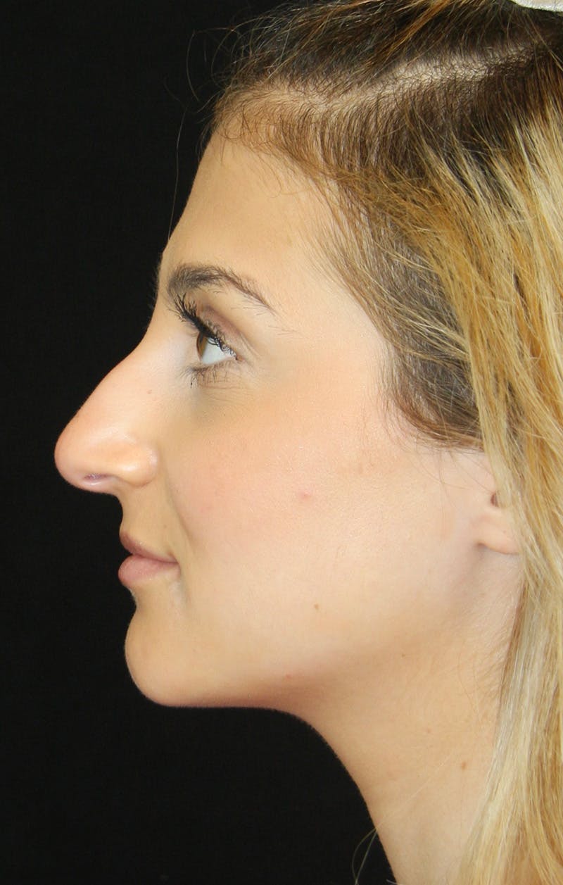 Rhinoplasty Before & After Gallery - Patient 189885106 - Image 9