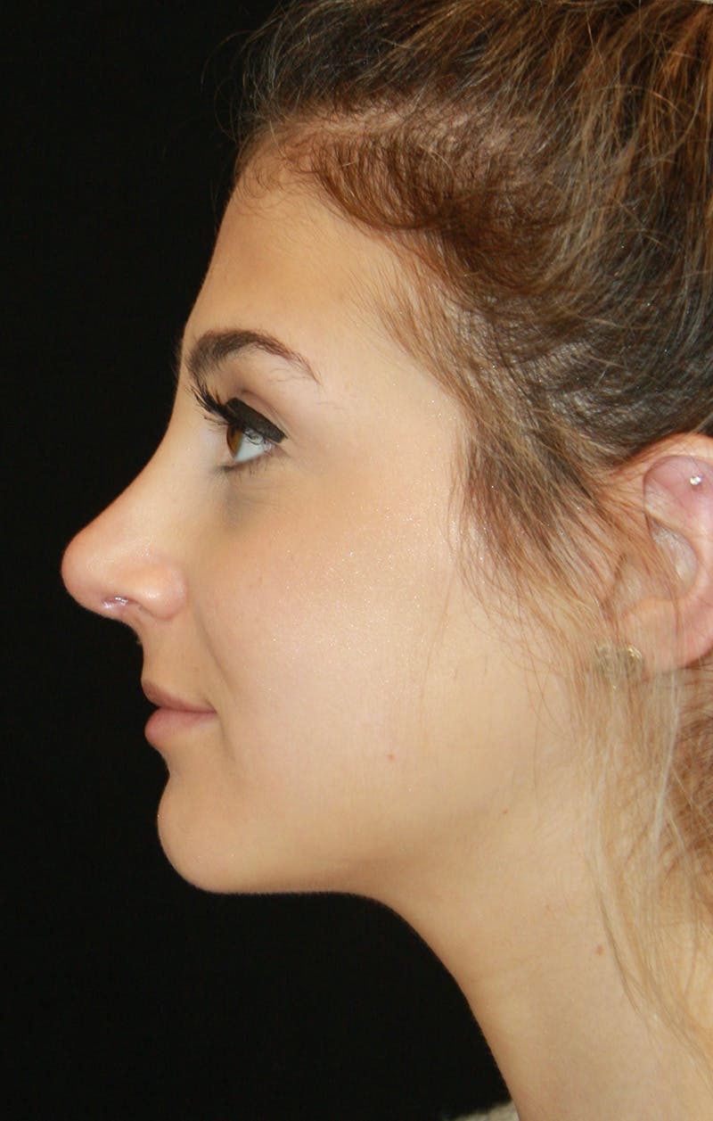 Rhinoplasty Before & After Gallery - Patient 189885106 - Image 10