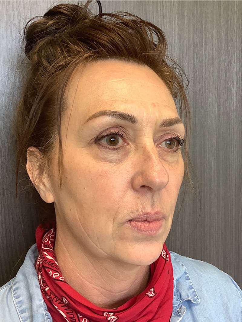 Fillers Before & After Gallery - Patient 161437100 - Image 3