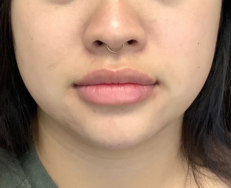 Fillers Before & After Gallery - Patient 161437106 - Image 2