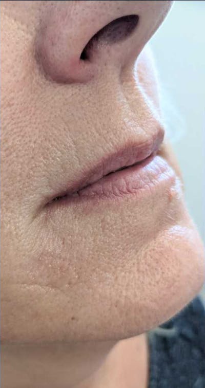 Fillers Before & After Gallery - Patient 161437108 - Image 1