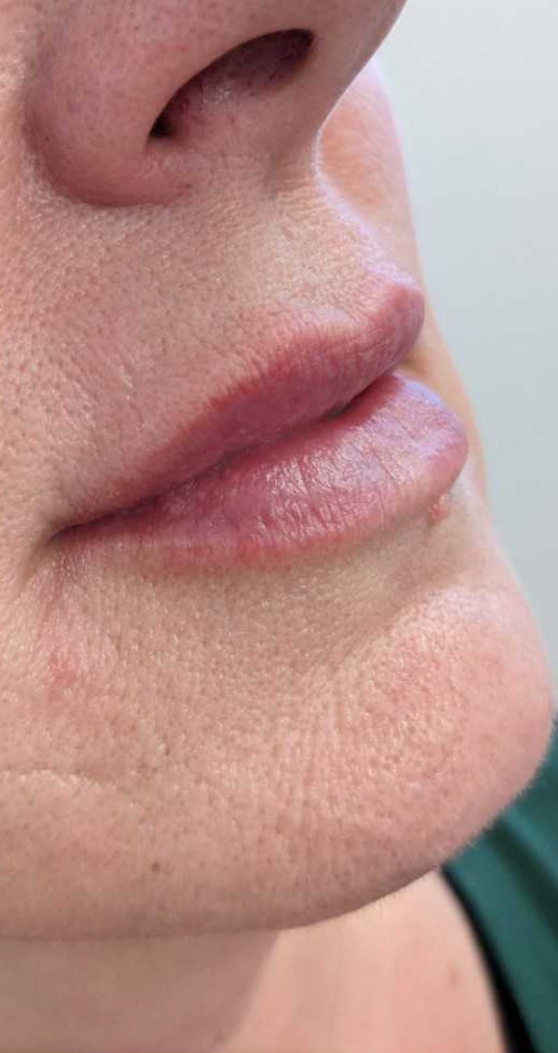 Injectables Before & After Gallery - Patient 202931 - Image 2