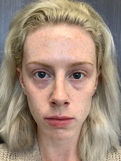 Fillers Before & After Gallery - Patient 161437117 - Image 1