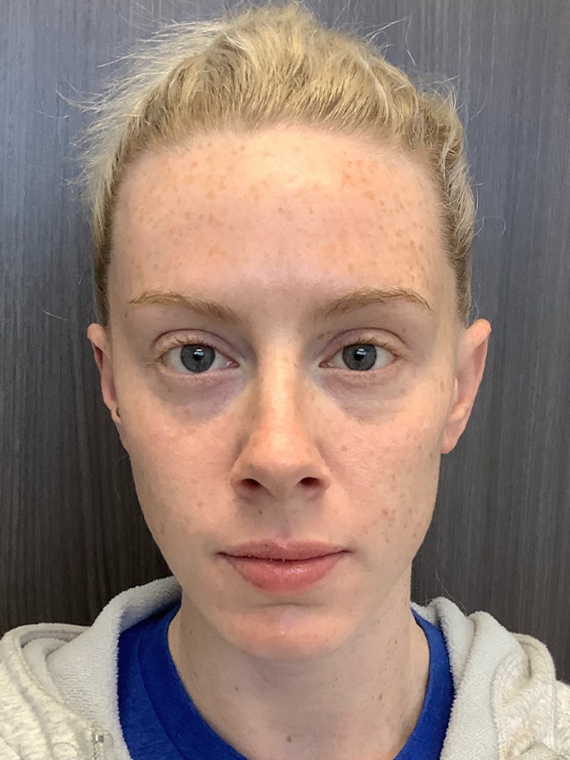 Fillers Before & After Gallery - Patient 161437117 - Image 2