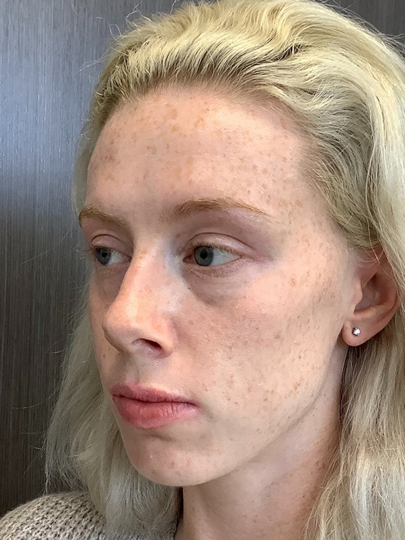 Fillers Before & After Gallery - Patient 161437117 - Image 3