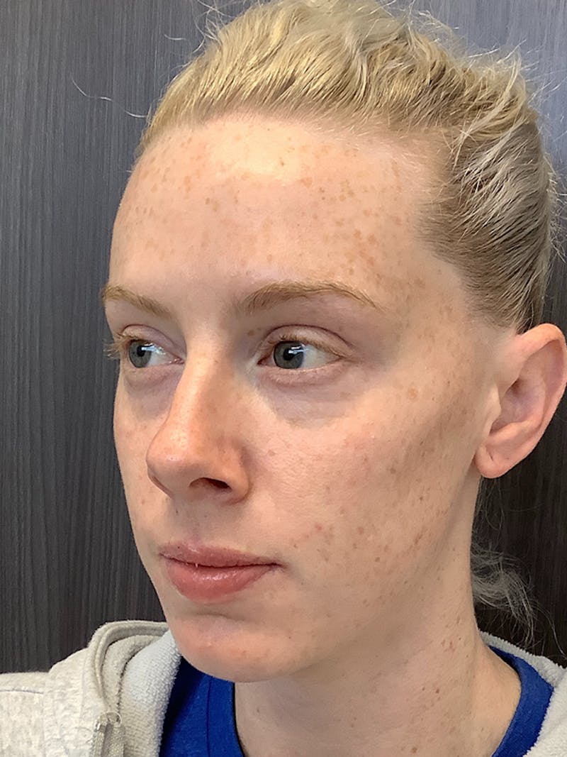 Fillers Before & After Gallery - Patient 161437117 - Image 4
