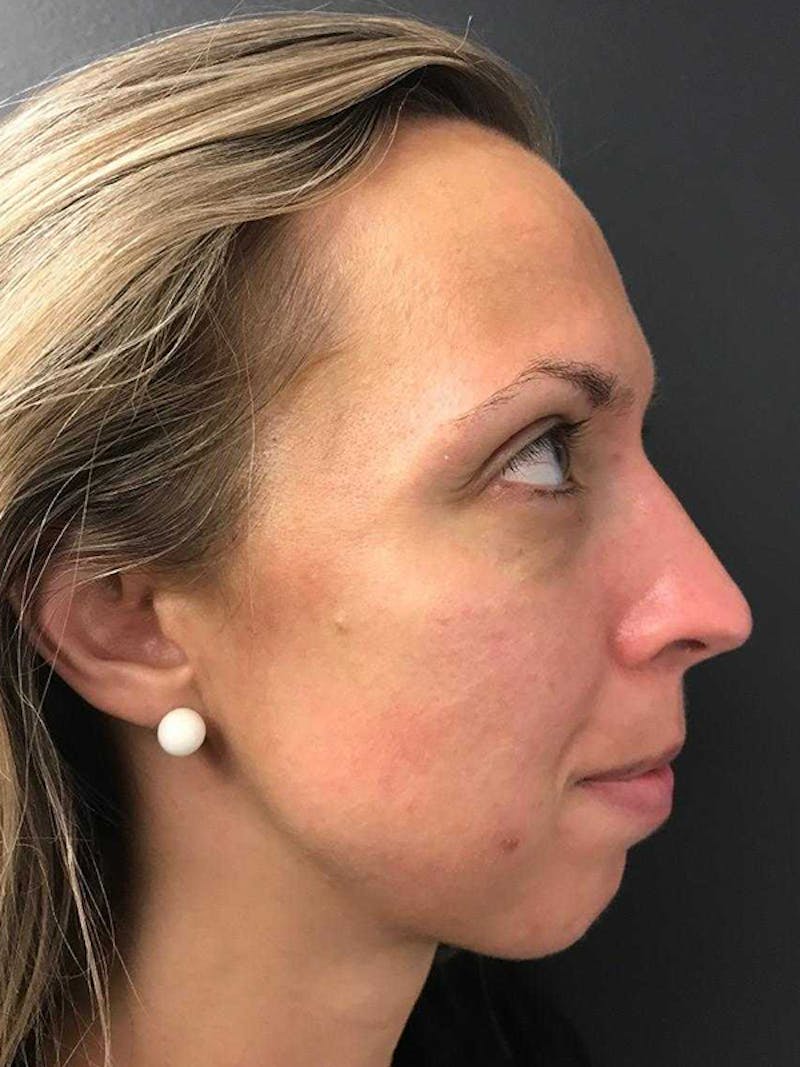 Fillers Before & After Gallery - Patient 161437120 - Image 1