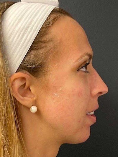 Fillers Before & After Gallery - Patient 161437120 - Image 2