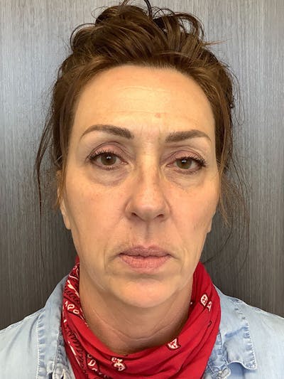 Hydrafacial Before & After Gallery - Patient 161437127 - Image 1