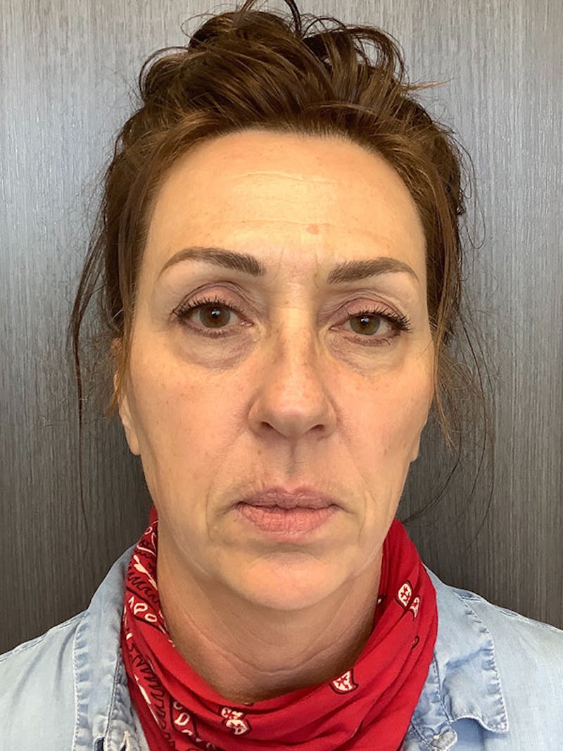 Hydrafacial Before & After Gallery - Patient 161437127 - Image 1