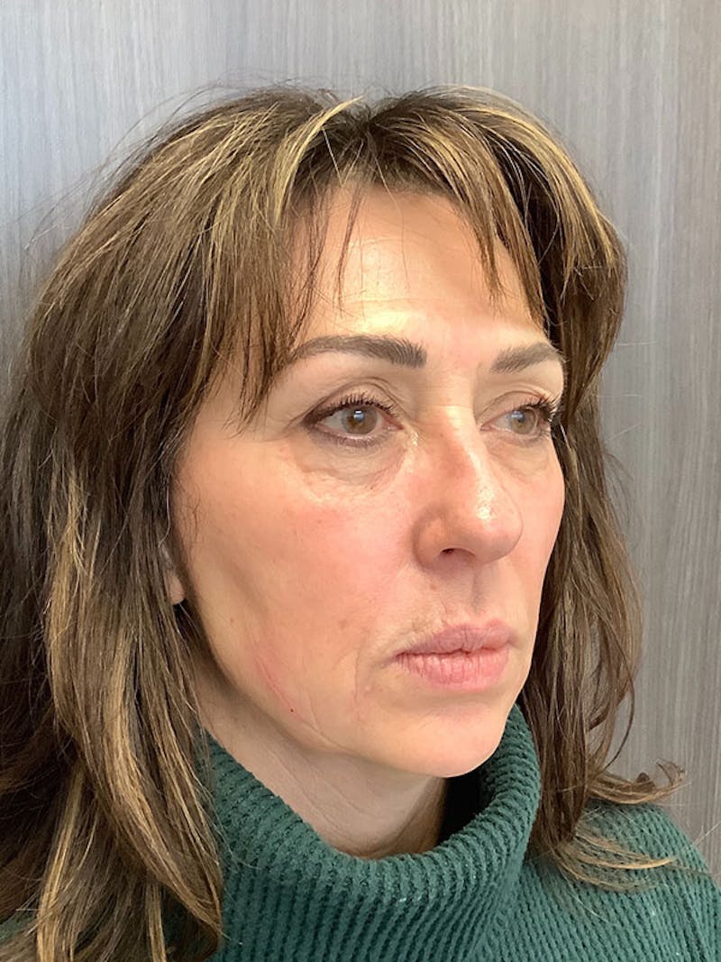 Hydrafacial Before & After Gallery - Patient 161437127 - Image 4
