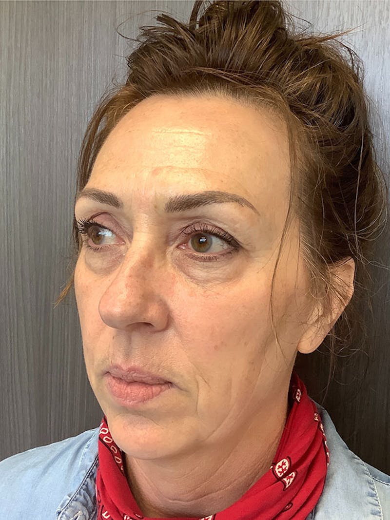 Hydrafacial Before & After Gallery - Patient 161437127 - Image 5