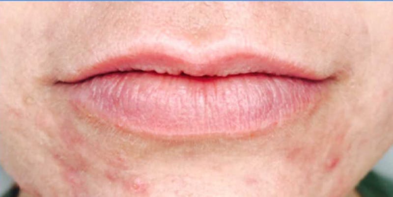 Fillers Before & After Gallery - Patient 161437132 - Image 1
