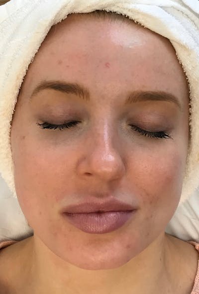Hydrafacial Before & After Gallery - Patient 161437133 - Image 1