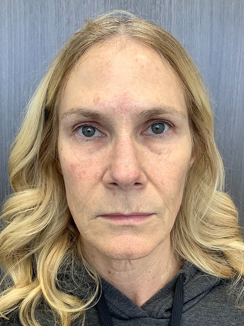 Fillers Before & After Gallery - Patient 161437137 - Image 1