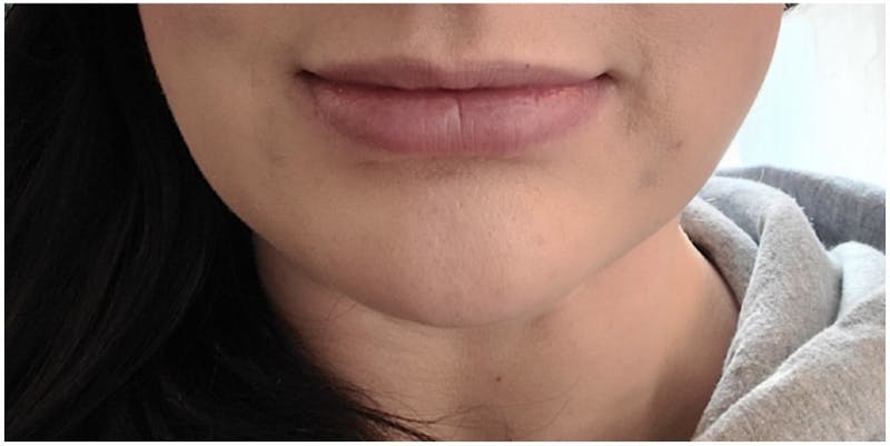 BOTOX Before & After Gallery - Patient 161437134 - Image 2