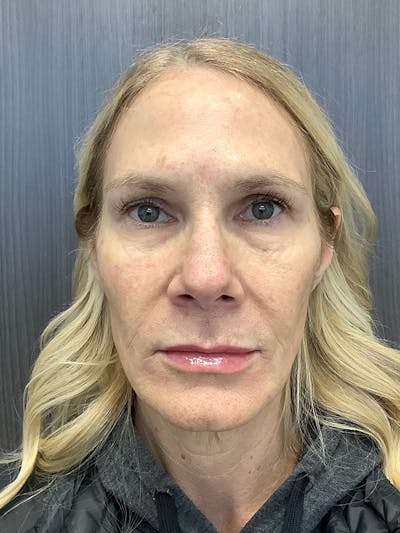 Fillers Before & After Gallery - Patient 161437137 - Image 2