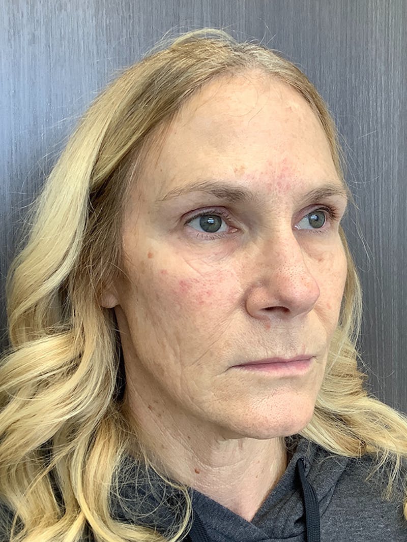 Fillers Before & After Gallery - Patient 161437137 - Image 3