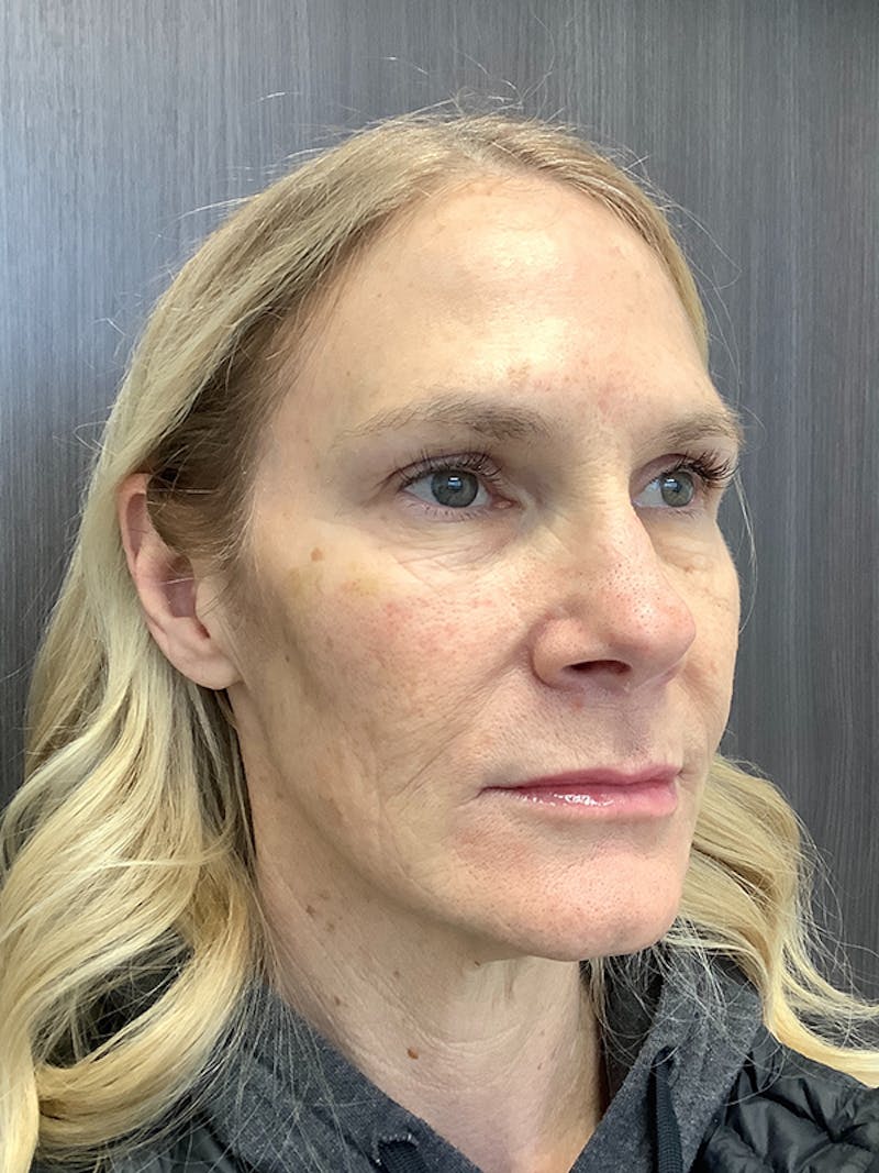 Fillers Before & After Gallery - Patient 161437137 - Image 4