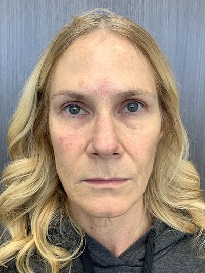 BOTOX Before & After Gallery - Patient 161437142 - Image 1