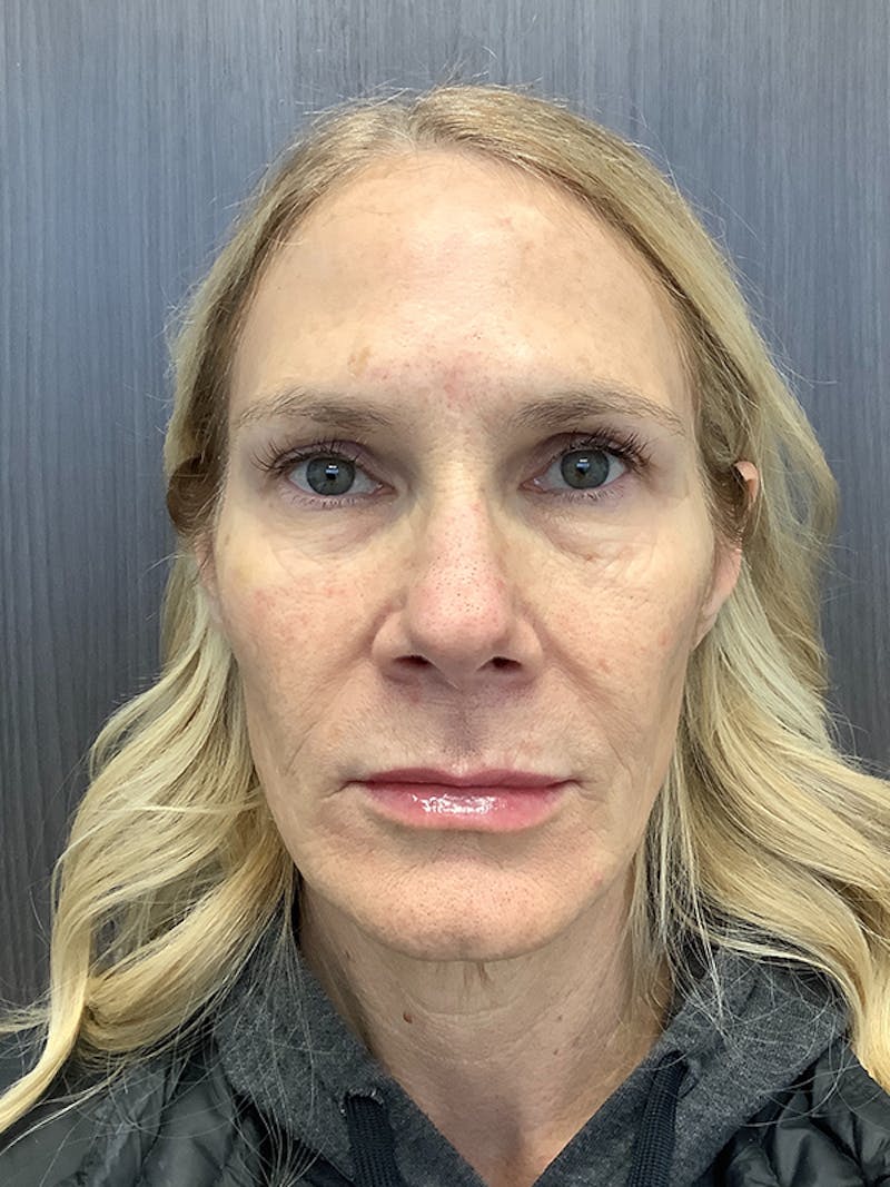 BOTOX Before & After Gallery - Patient 161437142 - Image 2