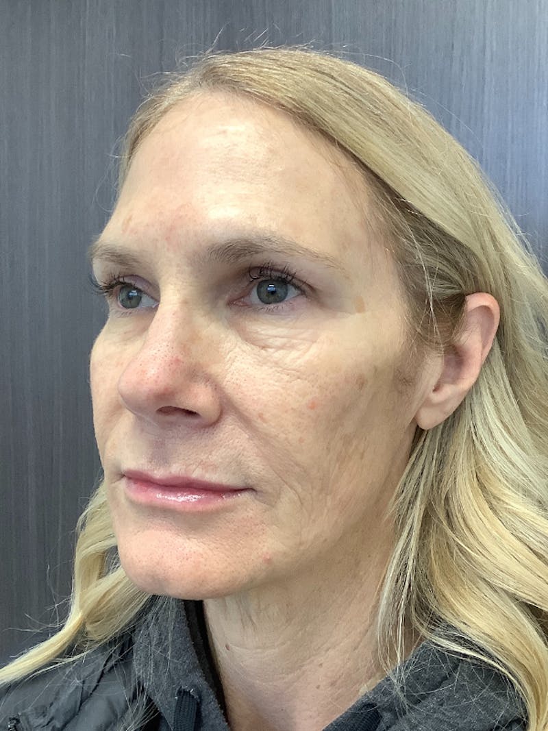 Fillers Before & After Gallery - Patient 161437137 - Image 6